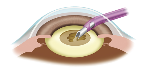 超音波にて水晶体を砕いて吸引除去